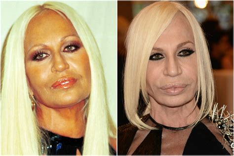 Donatella Versace lip plumper